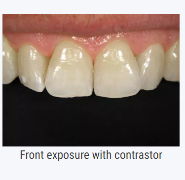 dentaleyepad kontrastor front billede