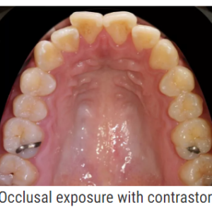 dentaleyepad kontrastor billede