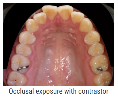 dentaleyepad kontrastor billede